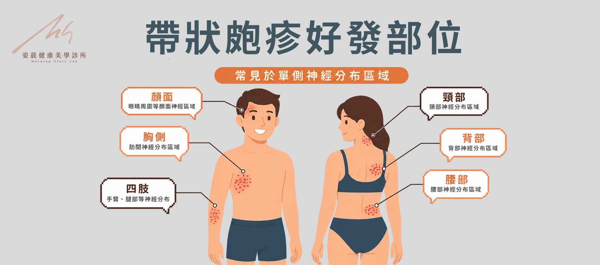 帶狀皰疹好發於哪些部位？ 帶狀皰疹可能發生於全身任何神經節分佈區域，常見部位包括：胸側、背部、腰部、頸部、顏面（眼睛周圍）與四肢